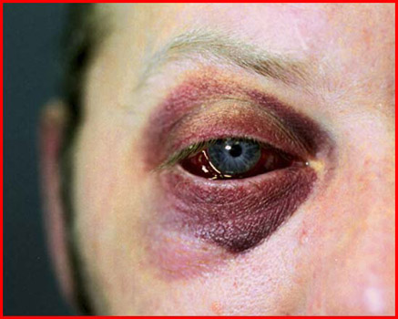 http://kingmagic.files.wordpress.com/2007/01/assault-black-eye.jpg